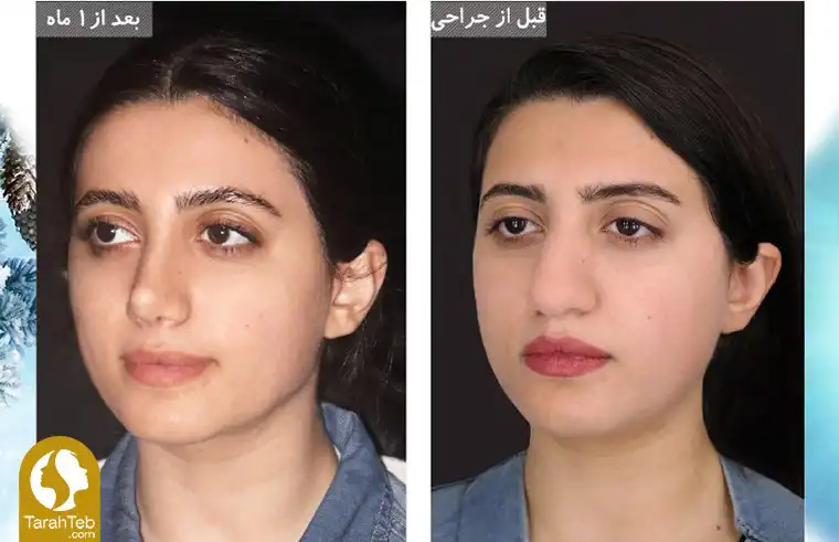 بهترین جراح زیبایی برای عمل بینی گوشتی