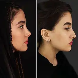 بهترین روش عمل بینی استخوانی