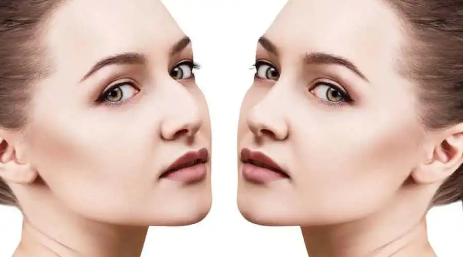 بهترین سن عمل بینی حداقل و حداکثر سن جراحی بینی