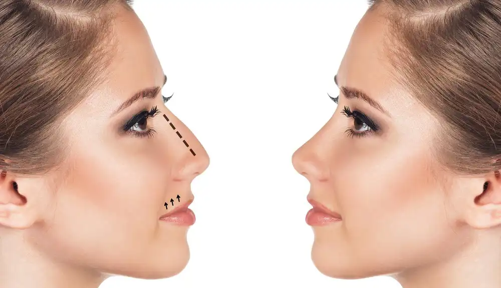 بینی زیبا چه خصوصیاتی دارد؟