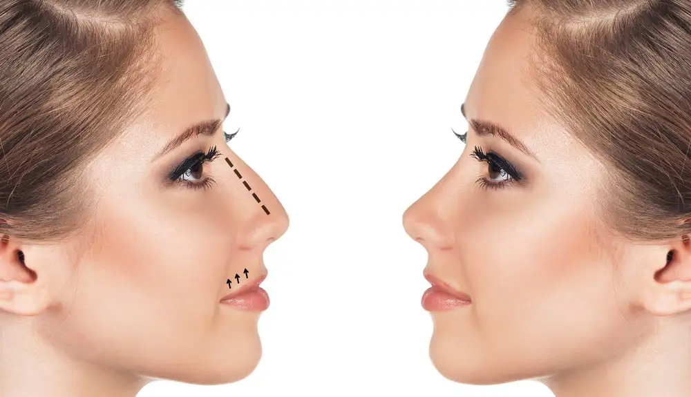 بینی زیبا چه خصوصیاتی دارد؟