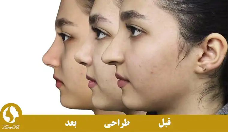 تشابه نتیجه جراحی بینی با طراحی