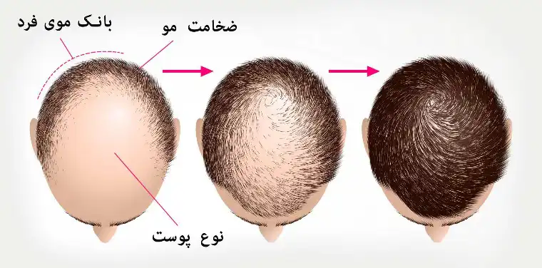 تشریح عملکرد کاشت مو