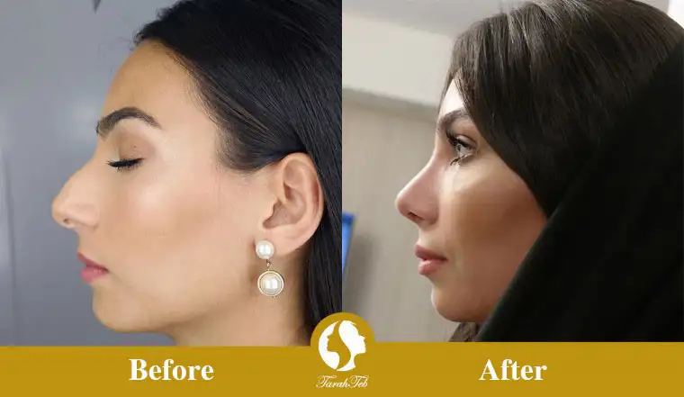 تصویر قبل و بعد از جراحی بینی با قالب کنترلی 1