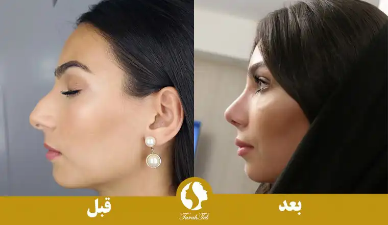 تصویر قبل و بعد از جراحی بینی با قالب کنترلی 1