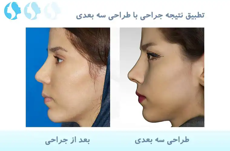 تطبیق نتیجه جراحی بینی با طراحی سه بعدی