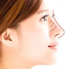 تغییر شکل بینی بدون جراحی