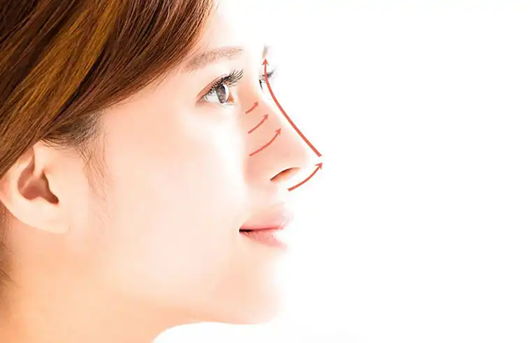 تغییر شکل بینی بدون جراحی