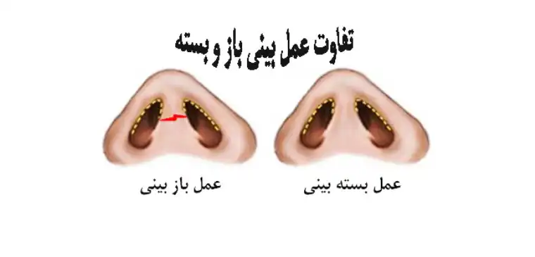 تفاوت عمل بینی باز و بسته