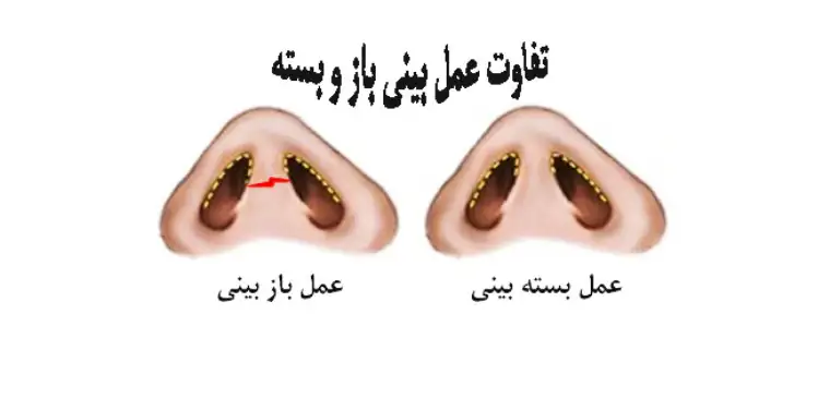 تفاوت عمل بینی باز و بسته