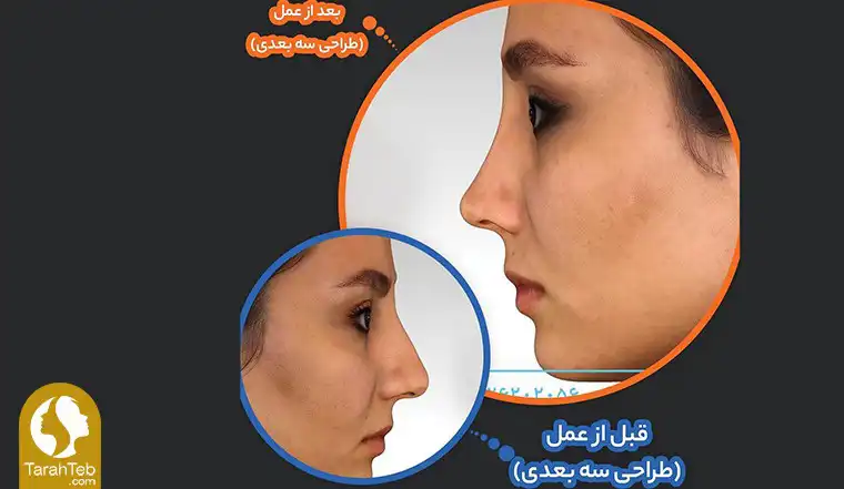 تکرار عمل بینی