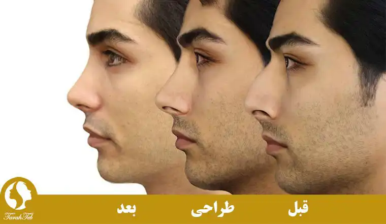 جراحی بینی با قالب کنترلی