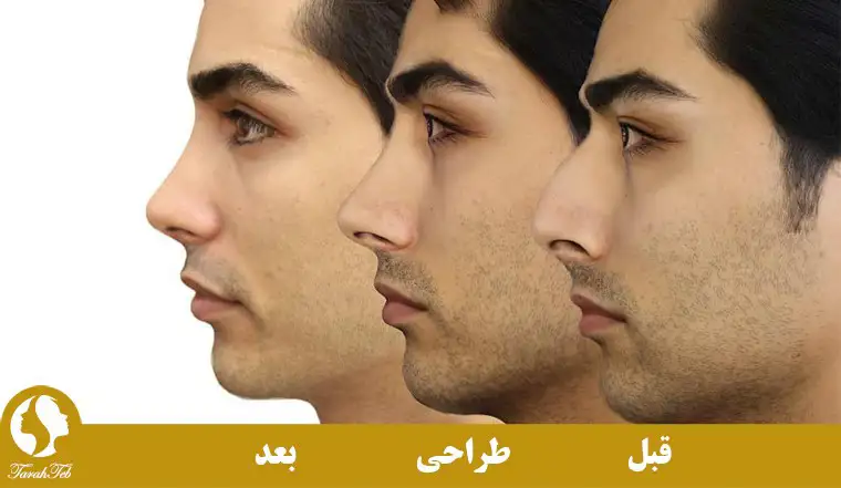 جراحی بینی با قالب کنترلی