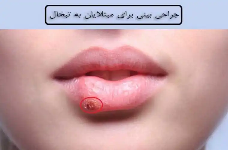 جراحی بینی برای مبتلایان به تبخال