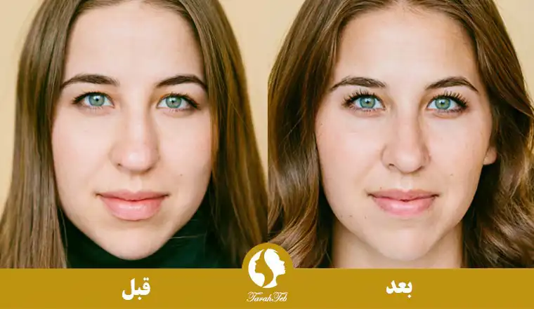 جراحی بینی طبیعی