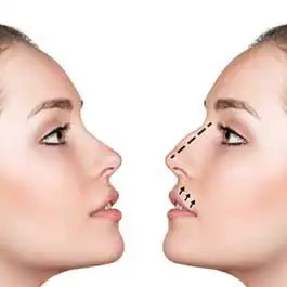 جراحی بینی و نگرانی های بعد از عمل!