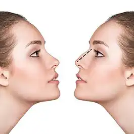 جراحی زیبایی بینی