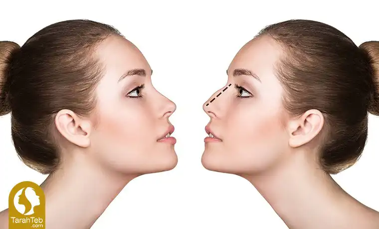 جراحی زیبایی بینی