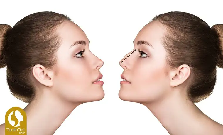 جراحی زیبایی بینی