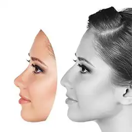 جراحی زیبایی بینی استخوانی