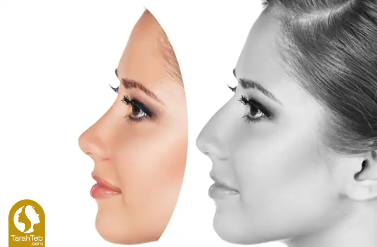 جراحی زیبایی بینی استخوانی