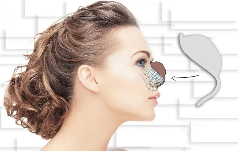 روش اجرا قالب کنترلی