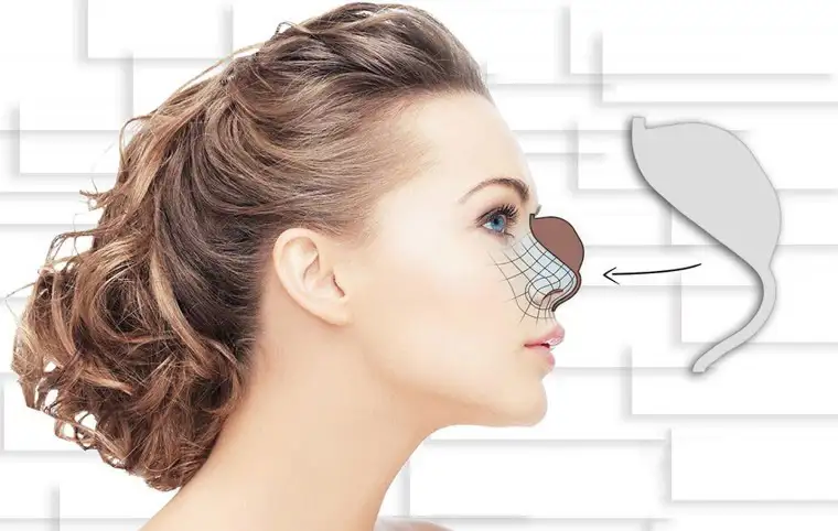 روش اجرا قالب کنترلی