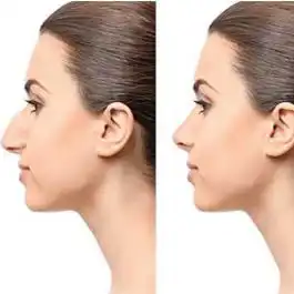 روش های اصلاح و رفع قوز بینی