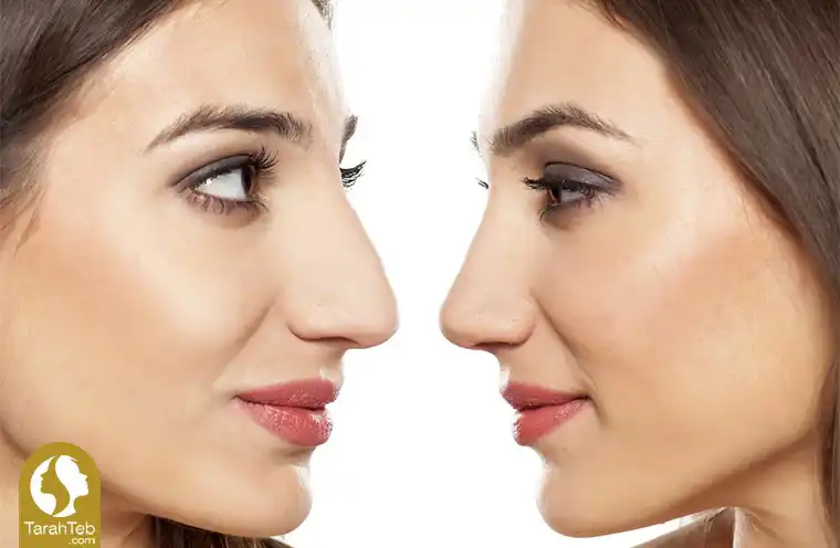 روش‌های کوچک کردن بینی