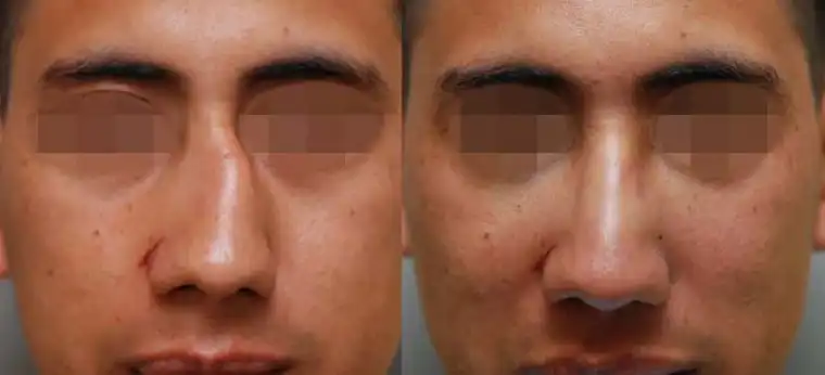 شکسته شدن استخوان بینی