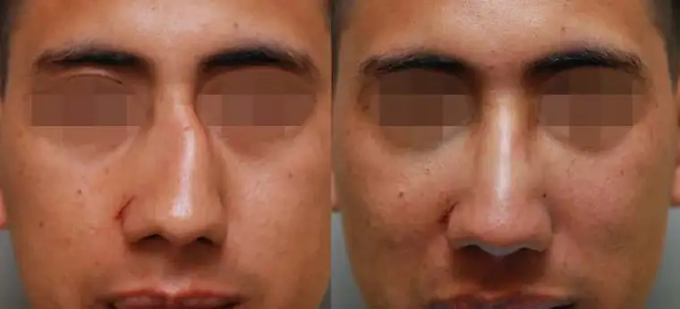 شکسته شدن استخوان بینی