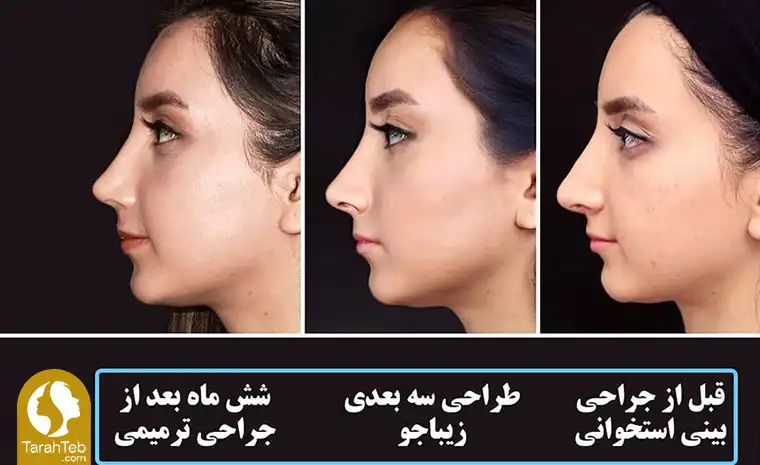 طراحی بینی قبل از عمل بینی استخوانی