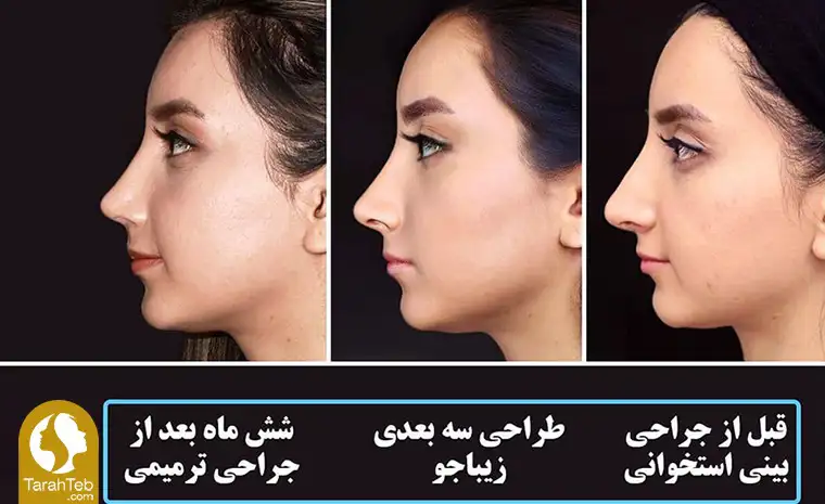 طراحی بینی قبل از عمل بینی استخوانی