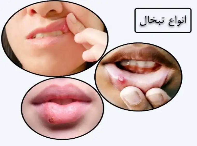 علت ایجاد تبخال
