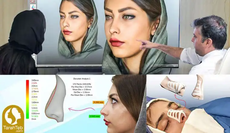 عمل بینی با اسکن سه بعدی و قالب کنترلی