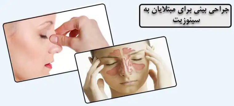 عمل بینی برای مبتلایان به سینوزیت