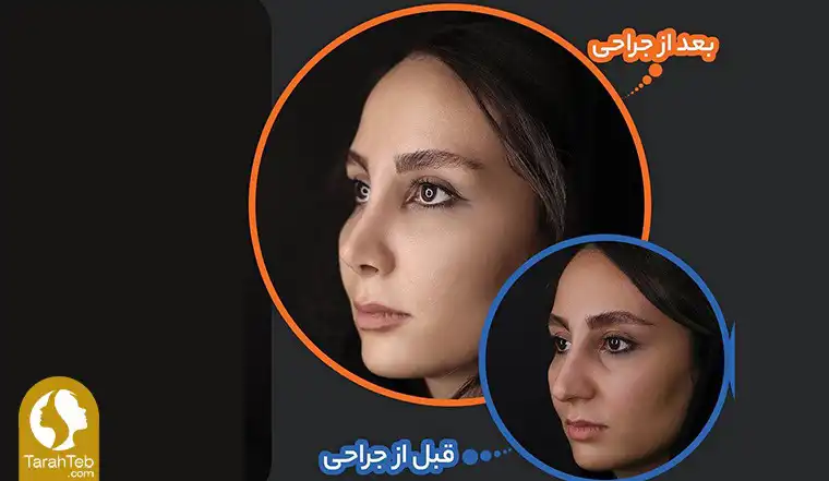 عمل بینی ثانویه