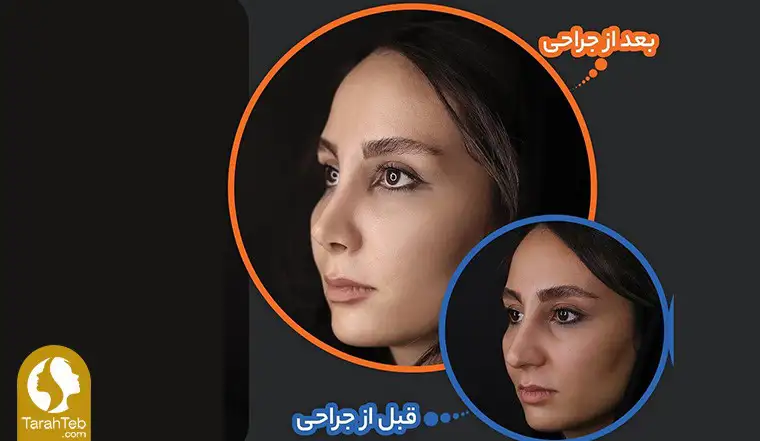 عمل بینی ثانویه