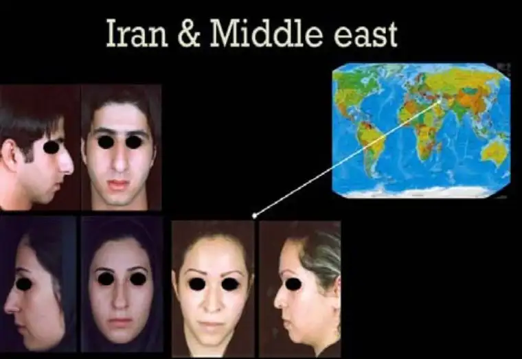 عمل بینی در ایران