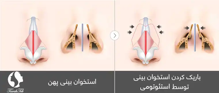 عمل بینی پهن