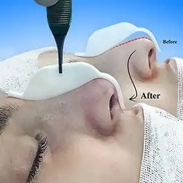 عمل جراحی بینی با قالب کنترلی
