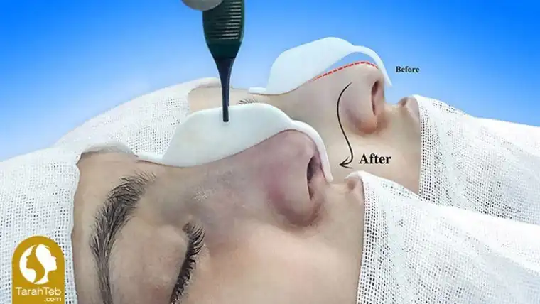 عمل جراحی بینی با قالب کنترلی