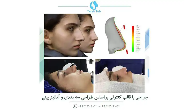 عمل زیبایی بینی