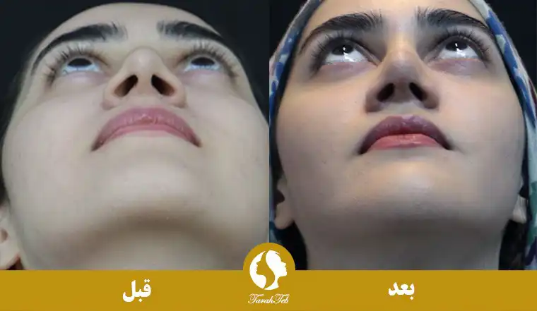 عمل کوچک کردن سوراخ های بینی