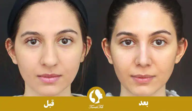 عکس قبل و بعد عمل بینی پهن