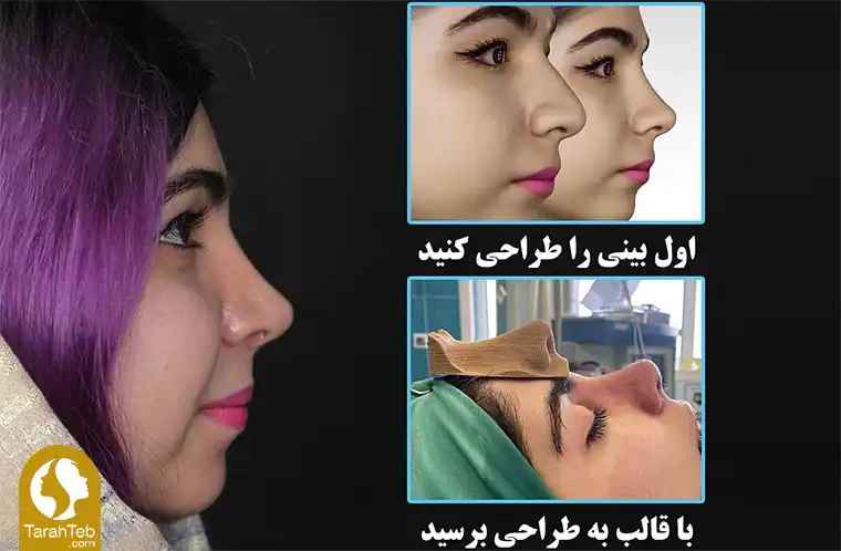 قبل از عمل بینی پهن