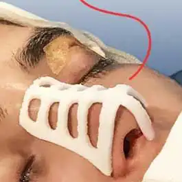 قرینه سازی بینی با قالب کنترلی