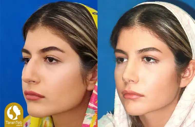 قوز بینی استخوانی