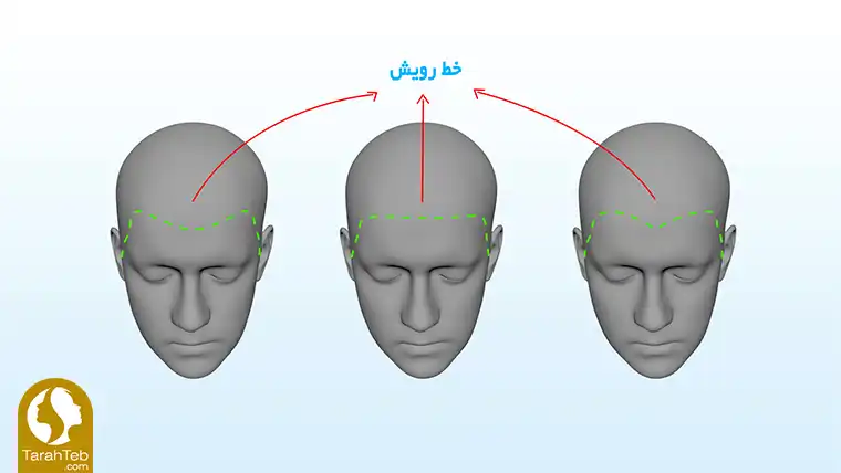 محل خط رویش مو در کاشت مو