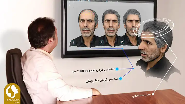 مرحله دوم کاشت مو